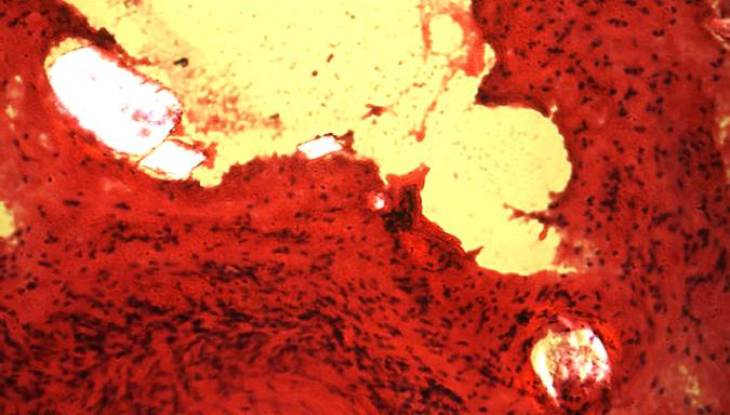 Klein- und grobschollige Degradationsprodukte im Kapselgewebe um ein AB-Polymernetzwerk fünf Wochen nach Implantation (HE-staining)